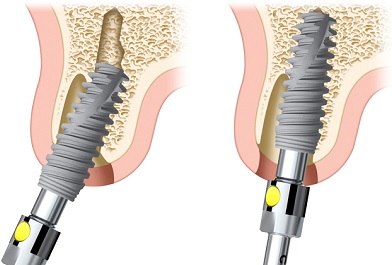 Adjustable implant orientation