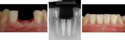 Зъбни импланти 3